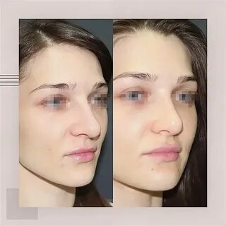 Текст песни ринопластика kai