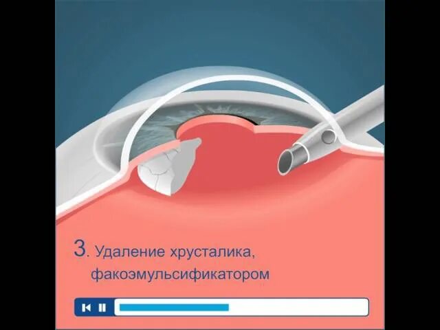 Платная операция по замене хрусталика