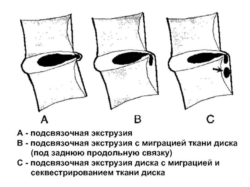 Экструзия диска l5 с миграцией. Транслигаментарная грыжа диска. Экструзия дисков позвоночника l5-s1. Экструзия диска l5 с миграцией. Секвестрированная экструзия l5-s1.