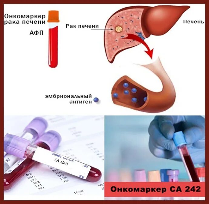 Опухолевые маркеры в крови. Онкомаркеры печени. Альфа-фетопротеин онкомаркер.