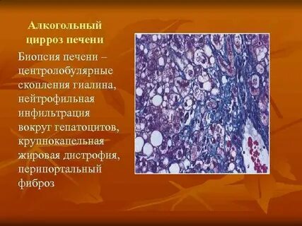 Цирроз печени при алкоголизме