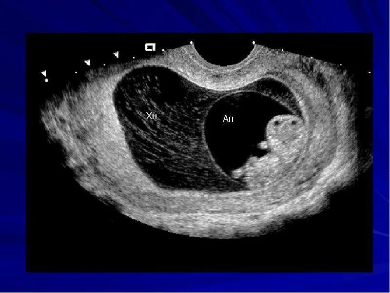 Плод в полости матки. Отслойка плодного яйца на УЗИ. УЗИ 6 недель беременности отслойка плодного яйца. Отслойка плодного яйца на ранних сроках УЗИ.