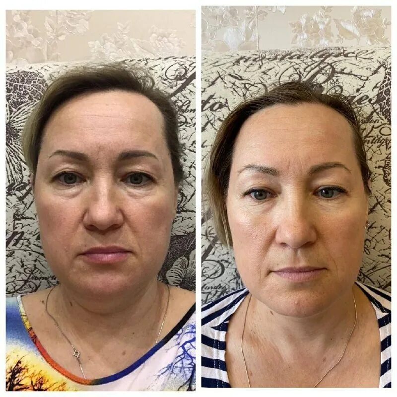 Поплыл овал лица. Упражнения для лица до и после. Гравитационный птоз кожи. Опущенный овал лица. Омолаживающий массаж лица до и после.