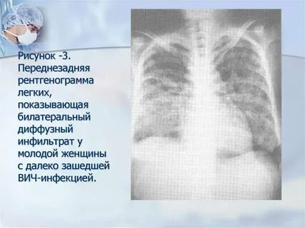 Туберкулез легких при вич