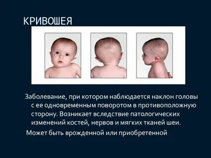 Младенец голова в одну сторону