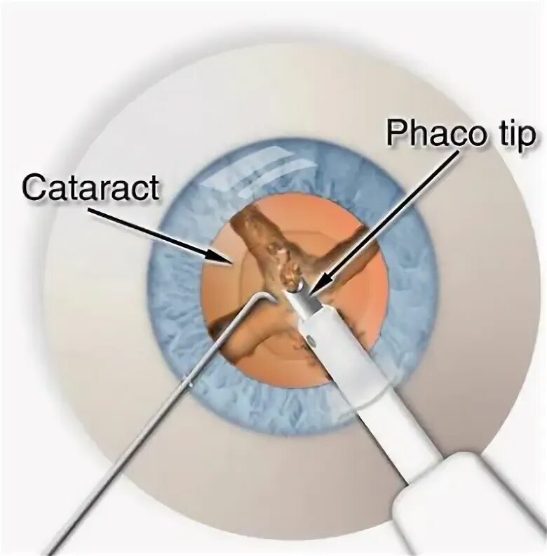 Ультразвуковая факоэмульсификация катаракты. Операция на хрусталик глаза. Замена хрусталика операция.