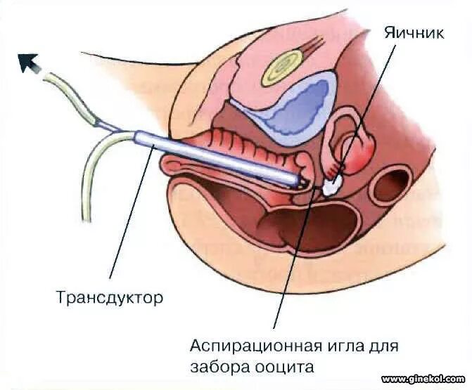 Пункция фолликулов при эко. Трансвагинальная пункция фолликулов. пункция фолликулов яичников. пункция забора яйцеклетки.
