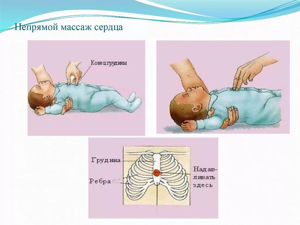 Жүрек өкпе реанимациясы. Правила непрямого т массажа сердца картинки. Жүрек өкпе реанимациясы. Непрямой массаж сердца рисунок. Окпе журек реанимациясы протокол.
