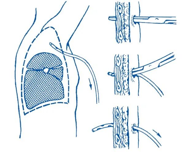 Пневмоторакс дренирование плевральной полости. Дренирование плевральной полости Бюлау. Дренирование плевральной полости при пневмотораксе. Дренаж по Бюлау при пневмотораксе.