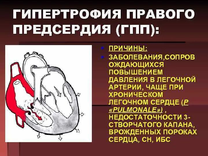 Гипертрофия правых отделов сердца. Гипертрофия правого предсердия. Причины гипертрофии левого предсердия сердца. Причины увеличения правого предсердия сердца. Дилатация полостей предсердий