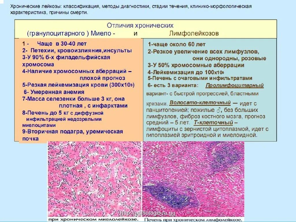 Хроническая миелолейкоз лимфолейкоз