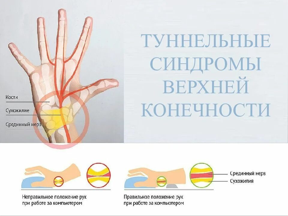 Карпальный туннельный синдром. Карпальный (кистевой) туннельный синдром. Туннельный синдром запястья туннельный. Запястный синдром синдром запястного канала. Что такое туннельный синдром запястья руки.