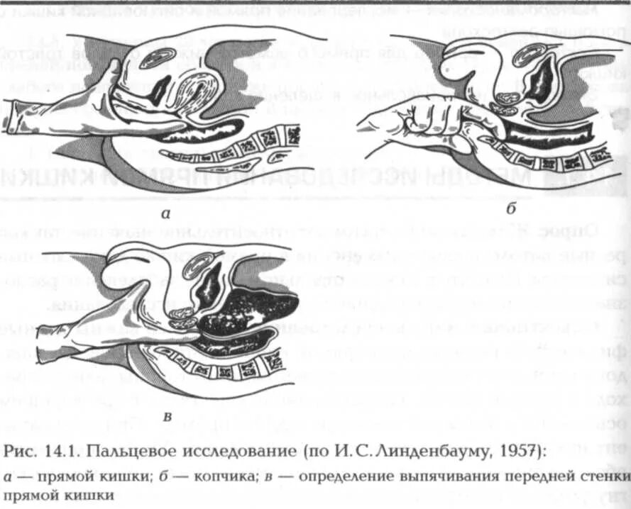 Ректальный анализ. Методика пальцевого обследования прямой кишки. Пальцевое ректальное исследование предстательной железы. Пальцевое ректальное исследование кишки. Методика выполнения пальцевого исследования прямой кишки.