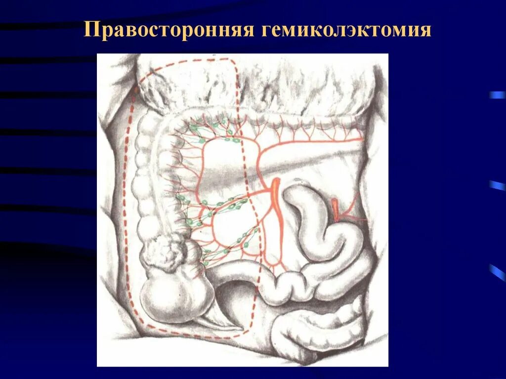 Резекция сигмовидной кишки анастомоз. Обструктивная гемиколэктомия. Операция левосторонняя гемиколэктомия. Левосторонняя гемиколэктомия техника. Расширенная правосторонняя гемиколэктомия.