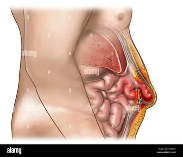 Abdominal hernia hi-res stock photography and images - Alamy