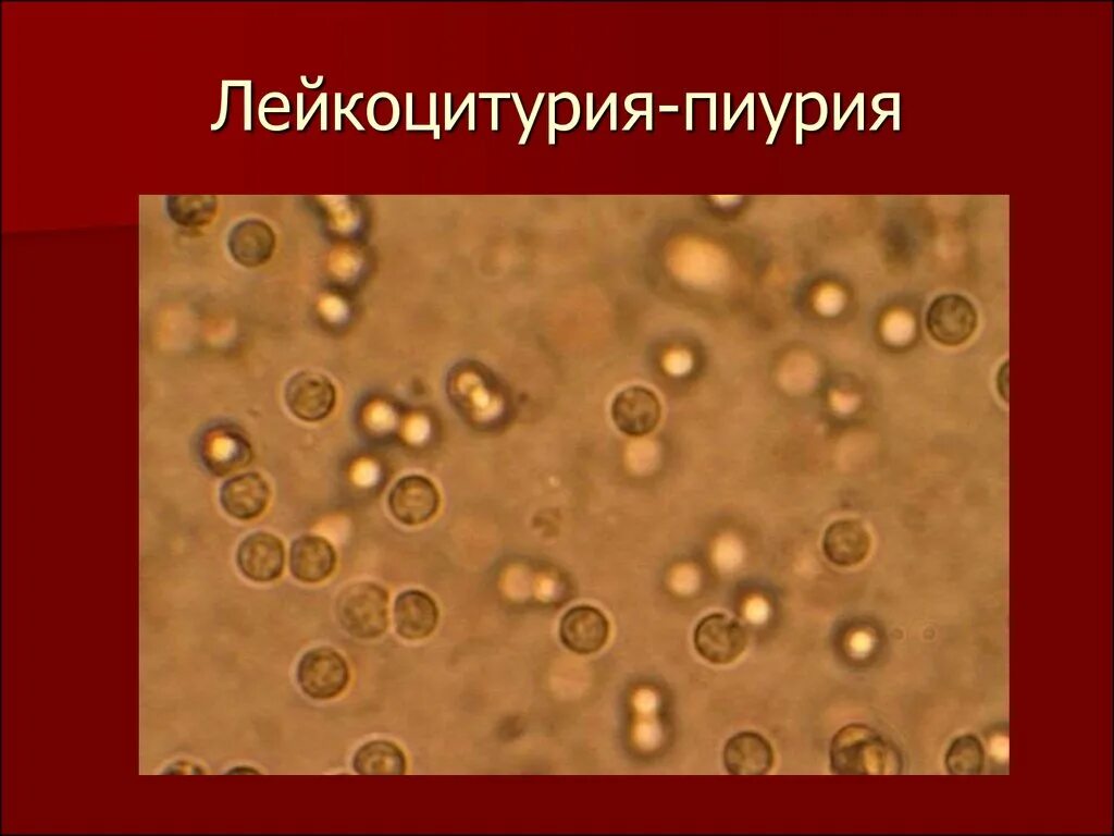 Лейкоциты в моче лейкоцитурия. Лейкоцитурия и пиурия. Лейкоциты и эритроциты в моче микроскопия. Микроскопия мочи лейкоцитоз. Лейкоциты в моче микроскопия.