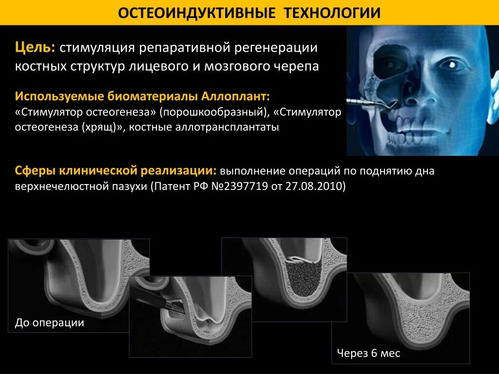 Остеоиндуктивные и остеокондуктивные материалы. Биоматериал Аллоплант. Стимулятор остеогенеза. Стимуляция репаративного остеогенеза. Аллоплант для суставов цена отзывы пациентов