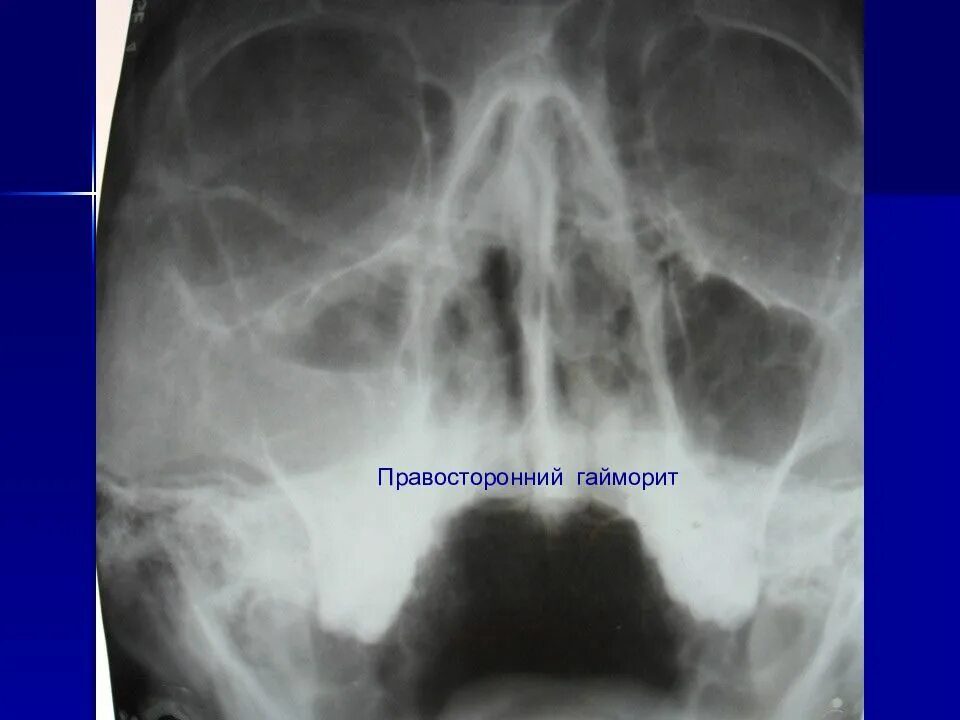 Пристеночный отек слизистой. Правосторонний верхнечелюстной синусит. Острый двусторонний верхнечелюстной синусит. Гнойный верхнечелюстной синусит. Левосторонний катаральный верхнечелюстной синусит.