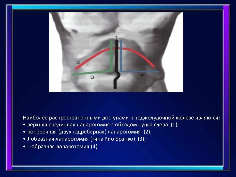 Какое лапаротомия. Доступы при операциях на поджелудочной железе. Верхнесрединная лапаротомия. Лапаротомия поджелудочной.