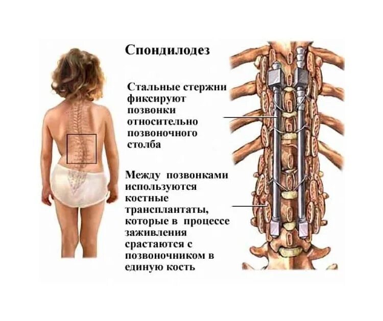 Спондилодез поясничного отдела позвоночника. Спондилодез Кейджем поясничного отдела. Транспедикулярная фиксация позвоночника и спондилодез. Передний спондилодез поясничного отдела позвоночника. Конструкция позвоночника операция