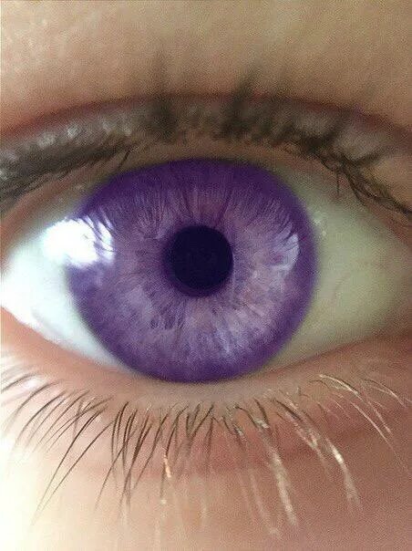 Генезис глазная. Фиолетовая гетерохромия. Фиолетовые глаза. Фиалковый цвет глаз. Сиреневые глаза.