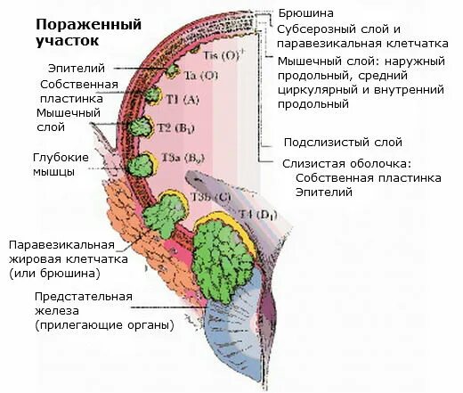 Паравезикальная клетчатка. Перивезикальная клетчатка мочевого пузыря. Паравезикальная клетчатка мочевого пузыря анатомия. Стадии опухоли мочевого пузыря.