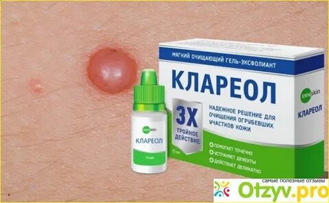 Средство от папиломо вирусной инфекции в аптеке
