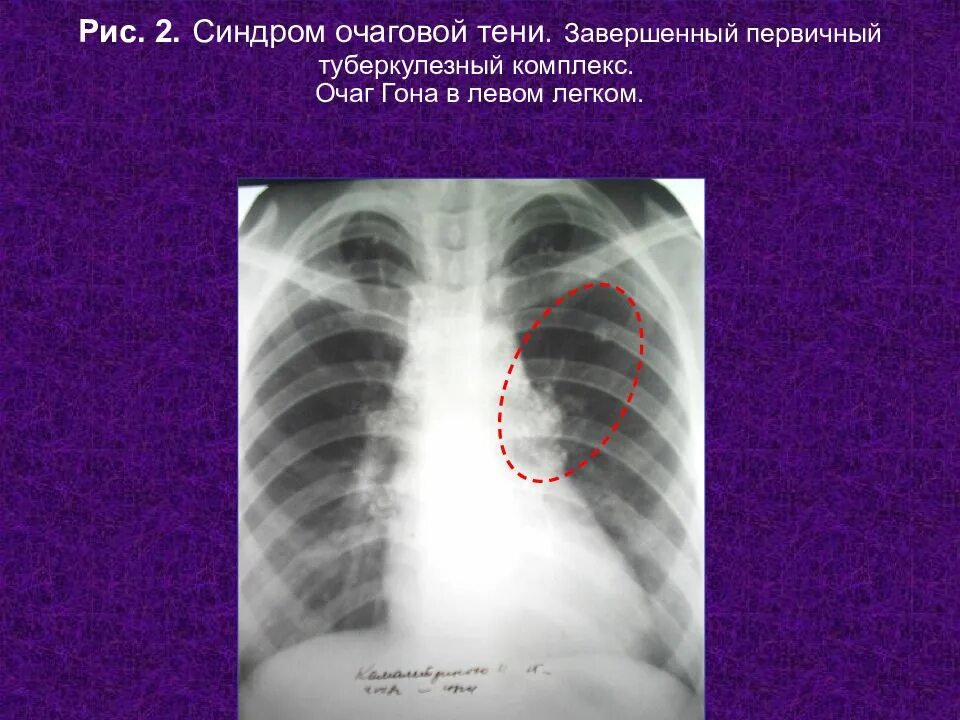 Очаг гона s3 левого легкого.. Первичный туберкулезный комплекс синдромы. Первичный туберкулезный комплекс и первичный туберкулез. Очаговая тень туберкулез. Тень в левом легком