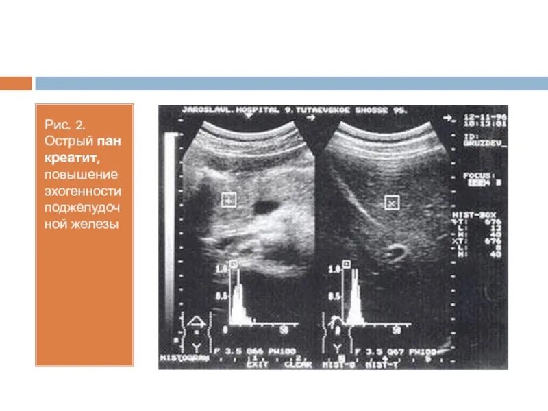 Что означает эхогенность печени. Эхогенность поджелудочной железы на УЗИ. Патологии поджелудочной железы на УЗИ. Эхоструктура поджелудочной железы. Повышена эхогенность поджелудочной железы на УЗИ.
