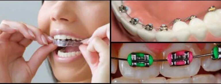 Аппарат хасса. Скобы для выравнивания зубов для детей. Железные скобы для зубов. Скобы для выпрямления зубов.