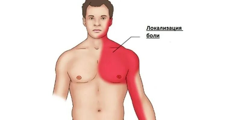 Инфаркт миокарда локализация боли. Локализация боли при инфаркте. Стенокардия локализация боли. Боль за грудиной при инфаркте. Иррадиация в левую лопатку