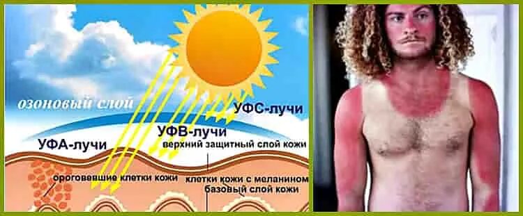 Загар образуется при. Солнечное излучение и влияние на кожу. Воздейсвттеи солнца на кожу. Воздействие солнечных лучей на кожу человека. Воздействие УФ излучения на кожу.