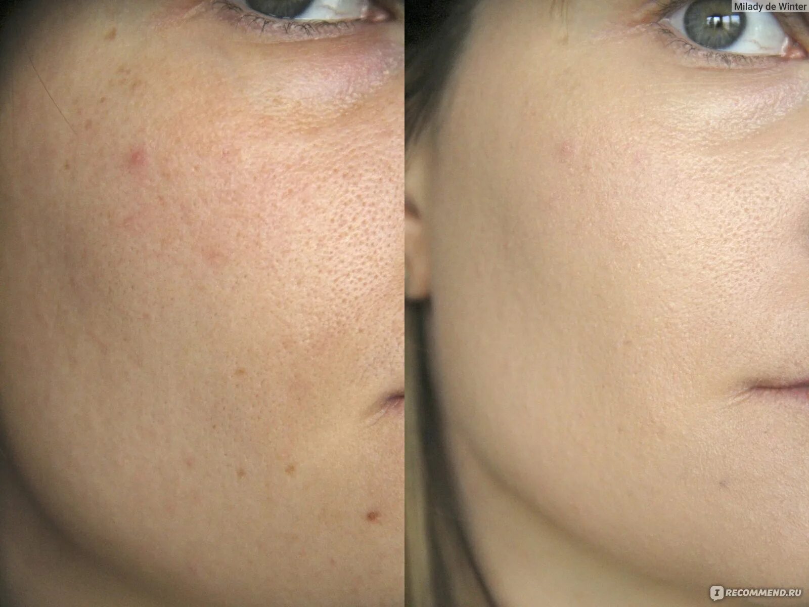 Эффект тонального крема bb glow. Bb glow тональный на год. Эффект бб глоу. Bb ideal skin процедура. Тональный эффект на 1 год.