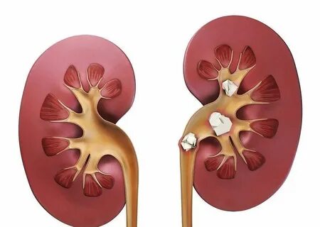 Камни в почка - лечение, удаление. Цена. Клиника Сеченова