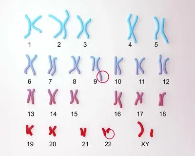 A 13-year-old Girl With Karyotype 47,xx,+i(22)(qll)