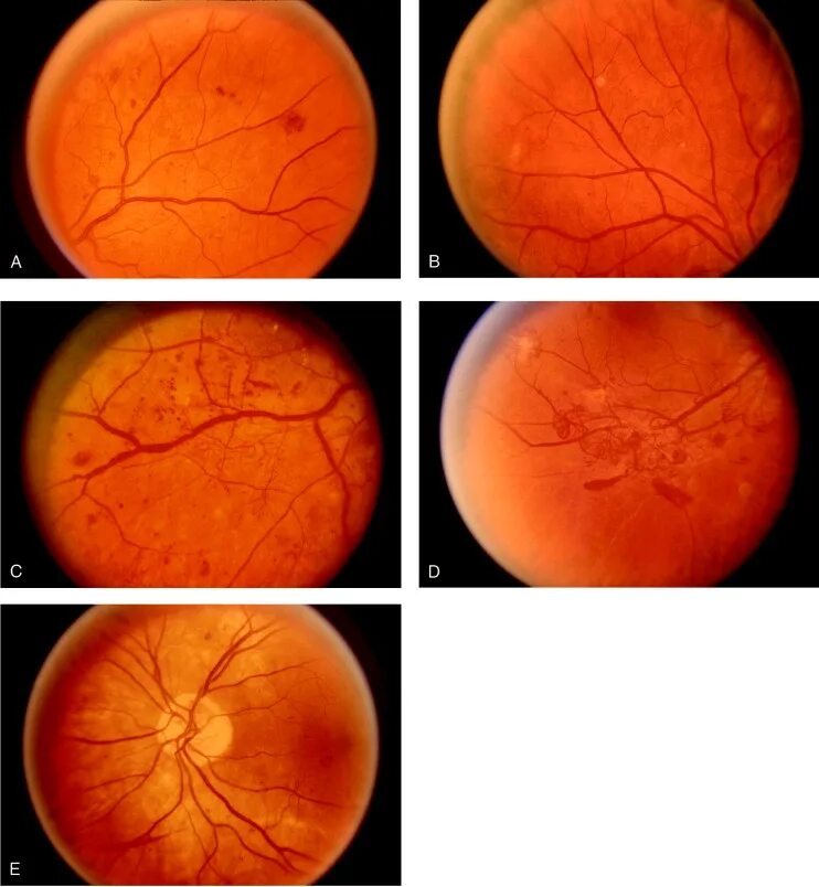 Препролиферативная ретинопатия. Ретинопатия отслойка сетчатки. ETDRS диабетическая ретинопатия. Непролиферативная диабетическая ретинопатия глазное дно.
