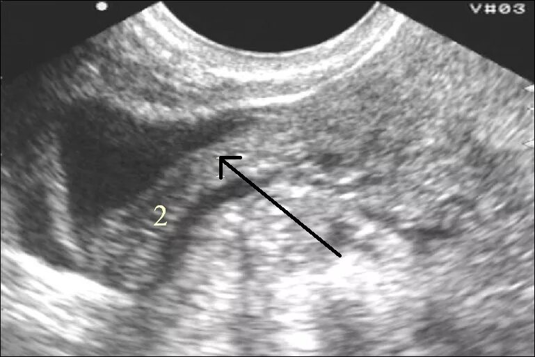 Трубы не визуализируются. Трансвагинальное узи снимки. Узи надпочечников описание. Трубы не визуализируются. Трубы не визуализируются.