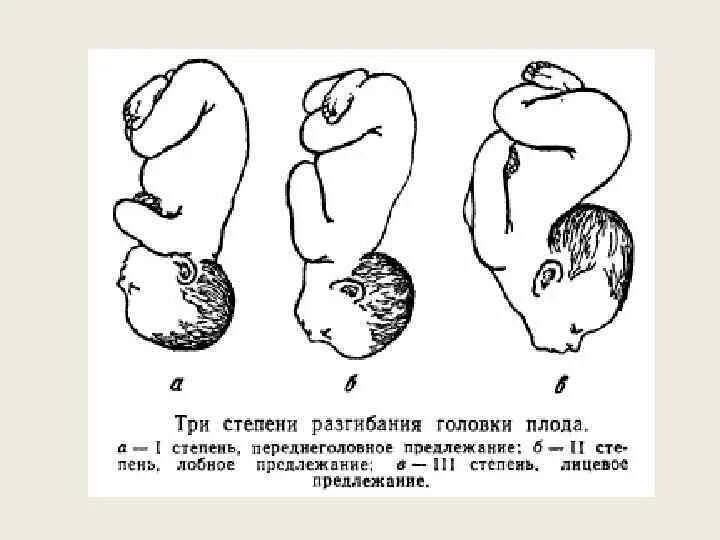 Передний вид головного предлежания. Разгибательное предлежание головы плода. Головное предлежание плода 2 позиция задний вид. Предлежание плода при беременности тазовое.