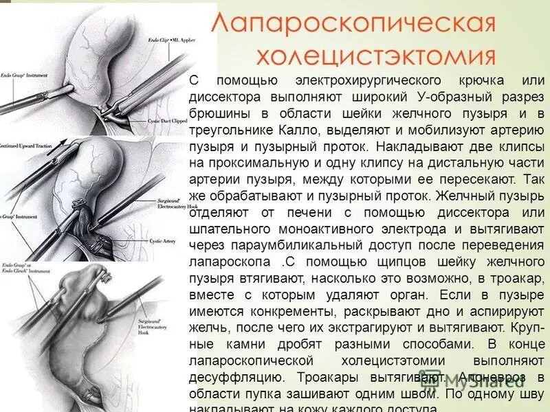 состояние после холецистэктомии код