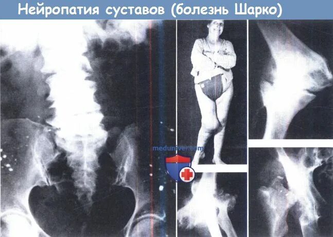 Невральная амиотрофия. Болезнь Шарко Мари тута. Болезнь Шарко нейропатия. Синдром шарко