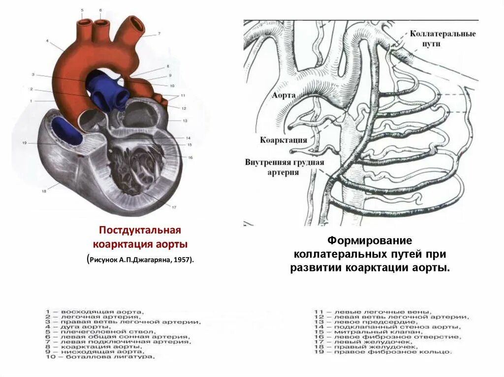 Формирование аорты. Коарктация аорты коллатеральное кровообращение. формирование коллатеральных путей при коарктации аорты. коарктация аорты коллатеральный кровоток. схема коарктации аорты.