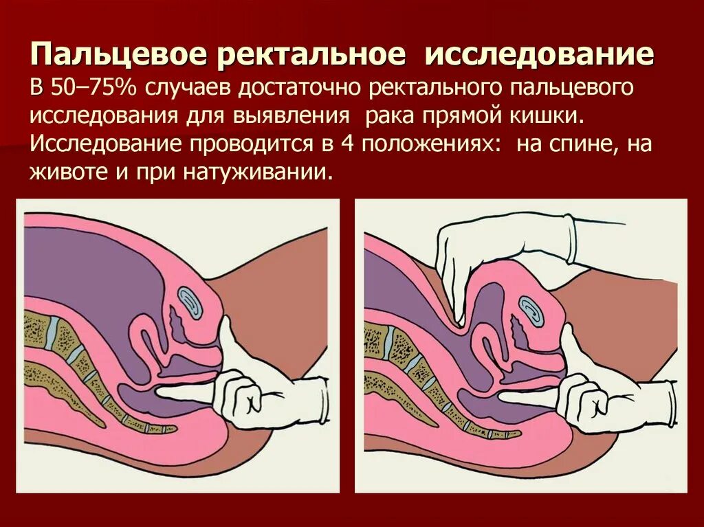 Женское ректальное. Пальцевое ректальное исследование. Пальцевое исследование прямой кишки. Пальцевое ректальное исследование (при). Ректальное исследование прямой кишки.