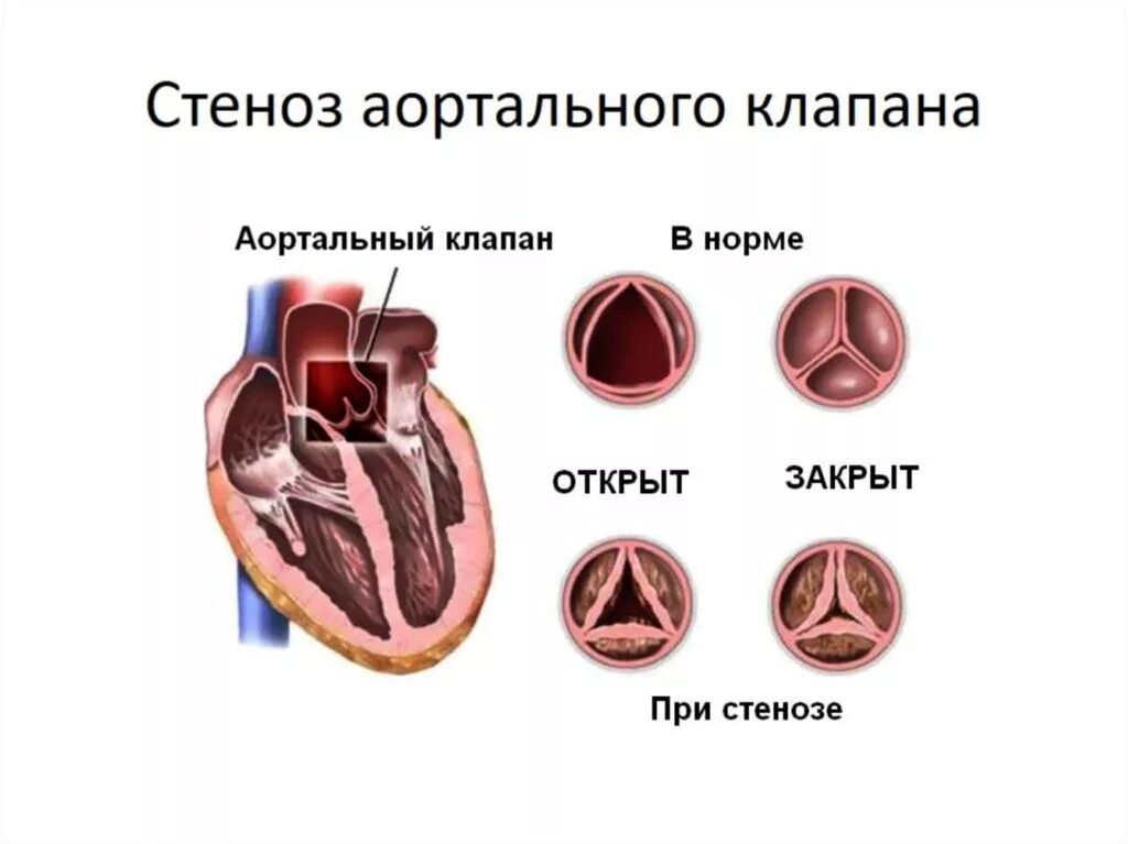 Осложнения стеноза