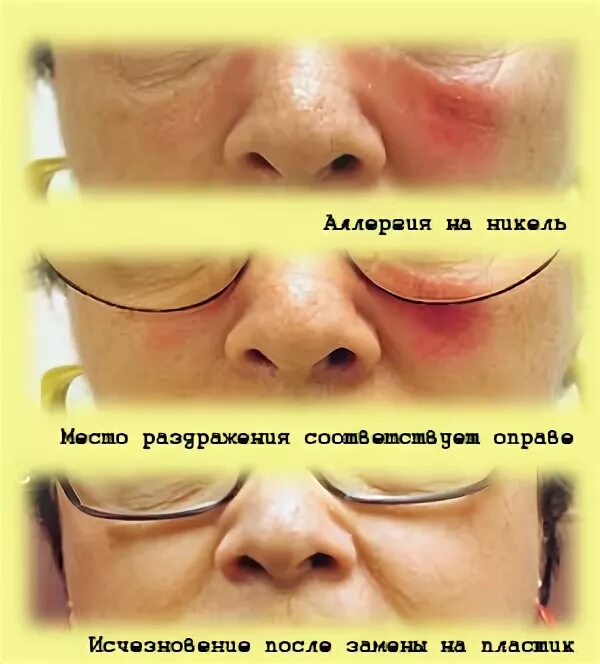 Аллергическое покраснение лица. Эритематозно-телеангиэктатический рощацеа. Человек надевает очки. Девушки в очках для зрения. Фотоаллергический дерматит.