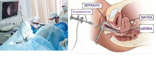 Сколько Нельзя Заниматься Сексом После Чистки