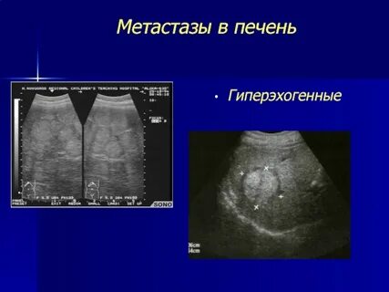 Очаговые mts печени