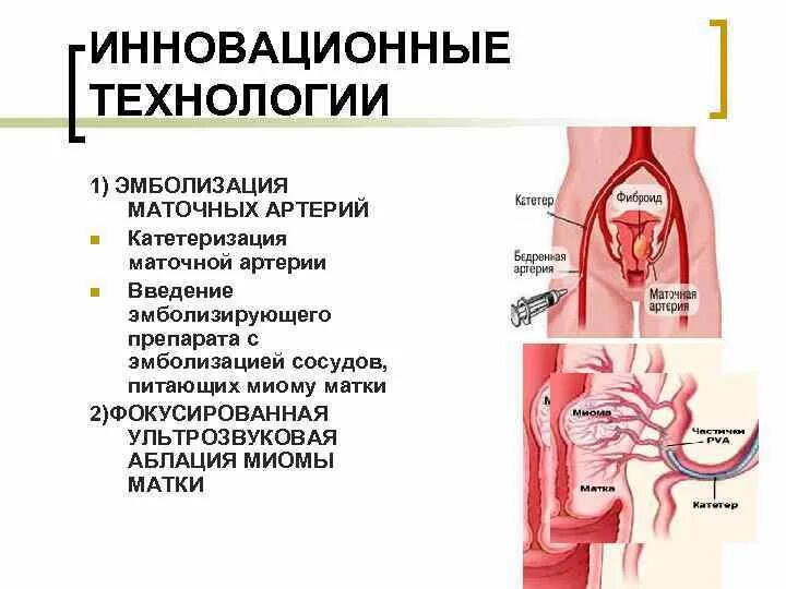 Эма миомы матки