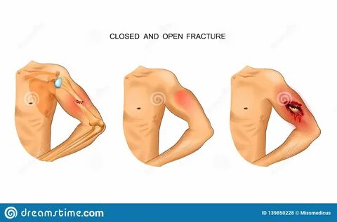 Open fracture