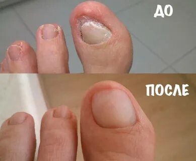 Не растут большие ногти на ноге
