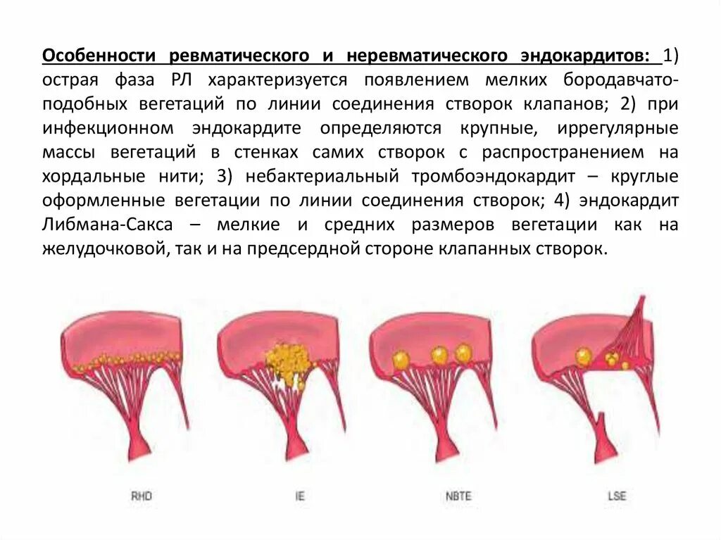 Ревматический острый бородавчатый эндокардит. Возвратно бородавчатый эндокардит. Бородавчатый эндокардит Либмана Сакса. Ревматический возвратно бородавчатый эндокардит. Вегетация сердца